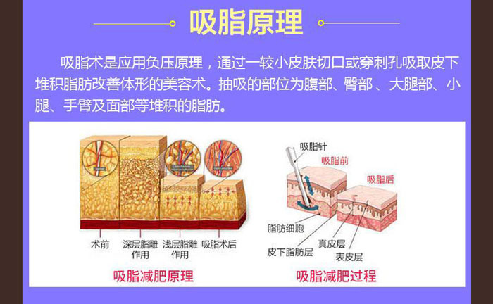 水動(dòng)力吸脂效果好嗎？