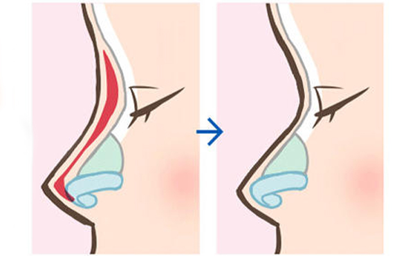 隆鼻假體取出后鼻子會不會和之前一樣?怎么做能盡快恢復原樣?