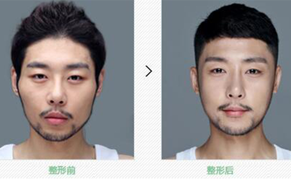 顴骨整形手術(shù)風(fēng)險(xiǎn)有多大?