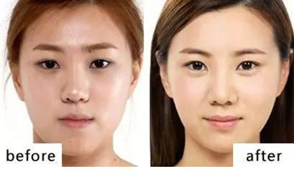 自體脂肪豐臥蠶有什么優(yōu)勢(shì)?能維持多久?