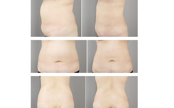 產(chǎn)后多久可以做腹部吸脂？