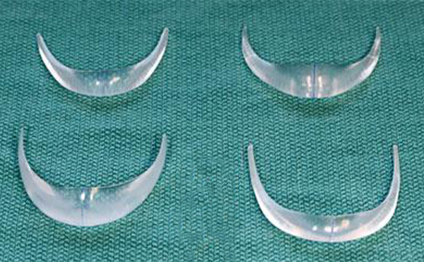 做了假體下巴幾天能消腫?時(shí)間久了假體會(huì)硬化嗎?