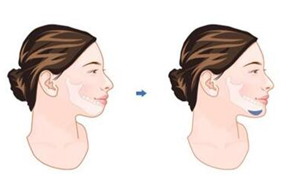 做假體墊下巴需要住院?jiǎn)?拆線疼不疼?