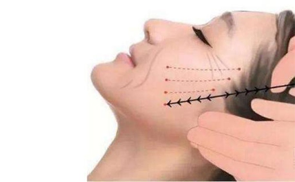 線雕提升適合哪些人做？