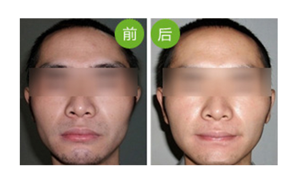 冰點(diǎn)面部脫毛值得做嗎？