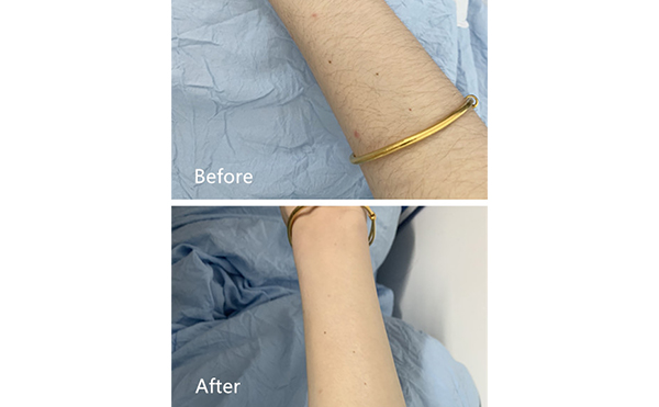 激光脫毛的影響因素有哪些？