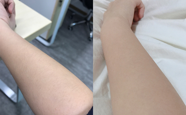 冰點脫毛有什么優(yōu)勢？