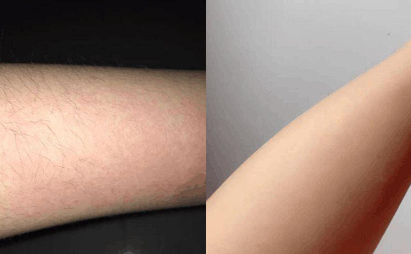 激光手臂脫毛安全嗎？