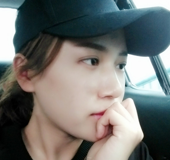 全臉脂肪填充效果術(shù)后2周效果圖