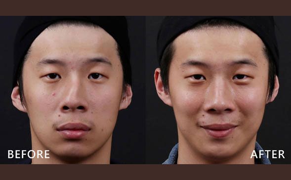 鼻骨矯正手術多少錢？鼻骨矯正手術危險嗎？