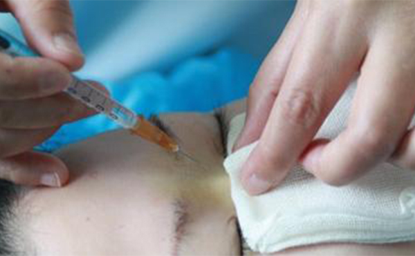 一般建議哪些人做注射隆鼻取出?注射隆鼻取出和假體隆鼻取出有何不同?