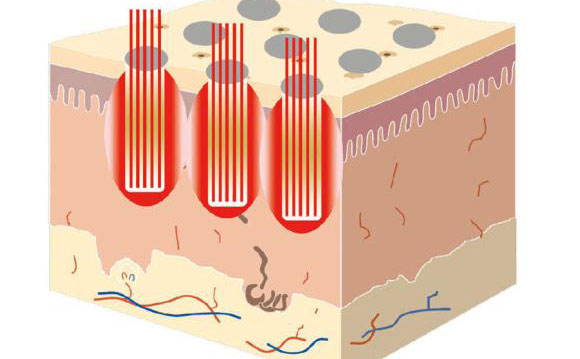 點(diǎn)陣激光祛斑后多久消失？