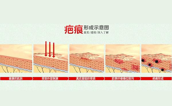 疤痕體質(zhì)割雙眼皮怎么樣?如何自測疤痕體質(zhì)?