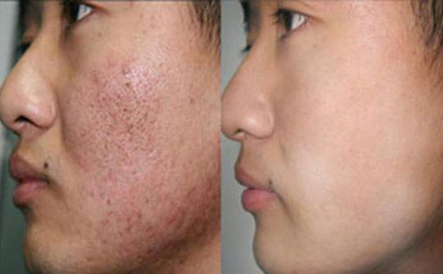 痘坑修復(fù)激光手術(shù)大概要多少錢？