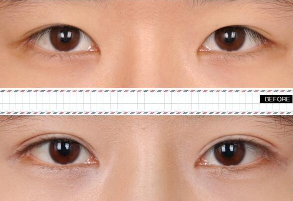 做雙眼皮價(jià)格是多少？哪種眼睛適合做雙眼皮呢?