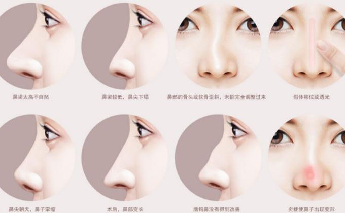 鼻尖整形大概多少錢？