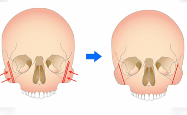 顴骨整形手術(shù)安不安全？有危險嗎？