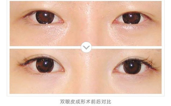 全切雙眼皮會越來越窄嗎?全切雙眼皮多久能恢復(fù)正常?