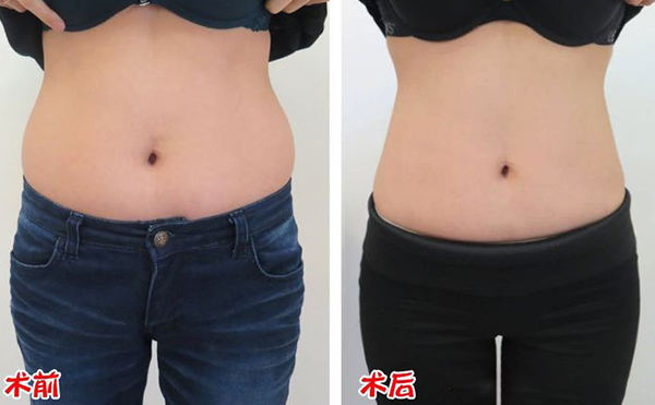 腹部吸脂效果如何？