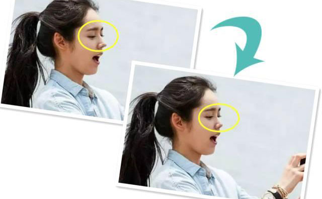 朝天鼻手術(shù)需要多少錢？