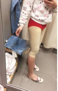 太原時(shí)光整形王國(guó)軍大腿吸脂案例2