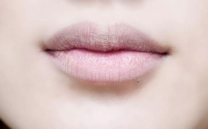 厚唇改薄多久完全恢復(fù)？