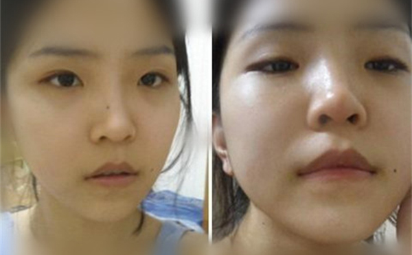 鼻翼缺損修復(fù)后和常人一樣嗎？