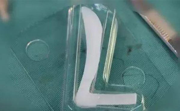 隆鼻假體取出后鼻子會變形嗎?