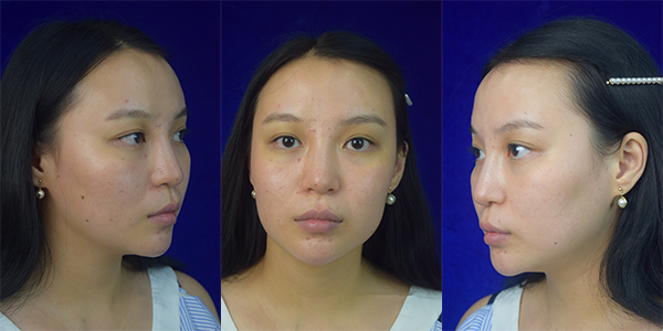 太原時光整形醫(yī)院案例