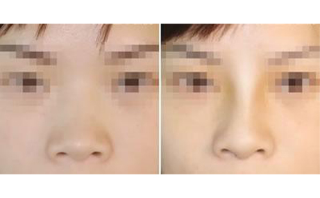 做隆鼻手術(shù)會(huì)留疤嗎？