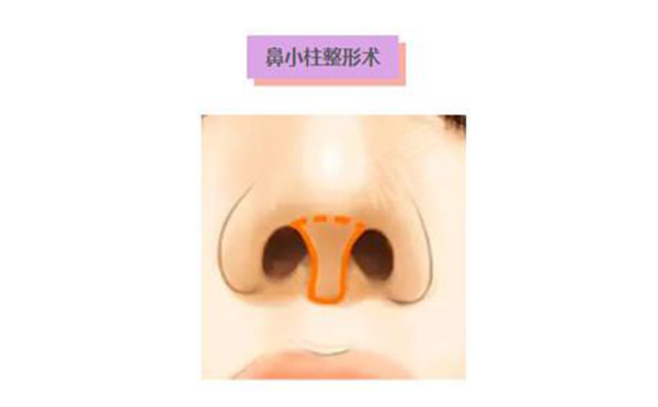 鼻小柱延長術(shù)是什么？鼻小柱延長手術(shù)有什么優(yōu)點