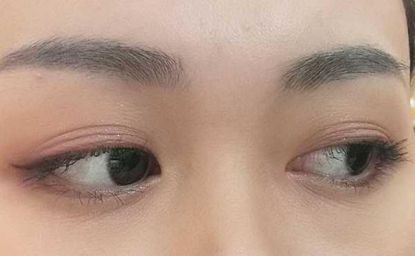 三眼皮是怎么回事?怎么變回雙眼皮?