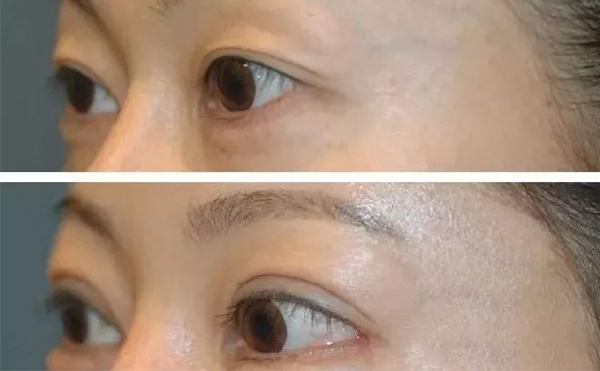 開外眼角需要多久恢復(fù)？