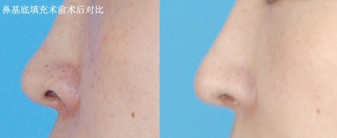 南京美貝爾做鼻基底效果術(shù)前術(shù)后對比