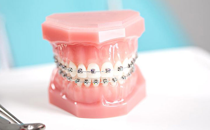 牙齒正畸費(fèi)用一般多少？