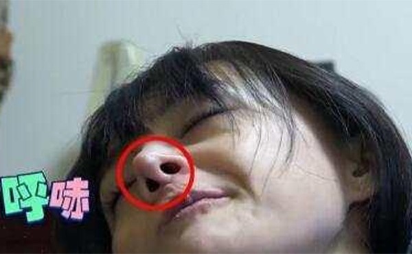 鼻假體取出后會變形嗎?能恢復(fù)原樣嗎?