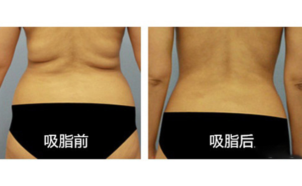 腹部吸脂需要多久恢復(fù)？