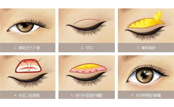 上瞼下垂價格多少?上瞼下垂術(shù)后有哪些問題?