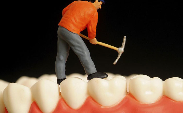 鑲牙要多少錢一顆費(fèi)用？