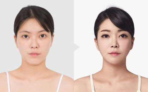 韓式埋線雙眼皮多久恢復(fù)自然？