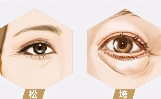 無痛去眼袋價格多少錢？