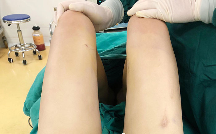 腿部吸脂手術(shù)多少錢？腿部吸脂會(huì)不會(huì)留下后遺癥？