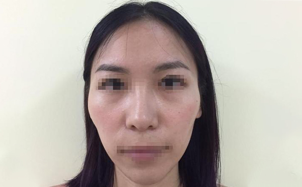 顴骨降低手術(shù)疼不疼？