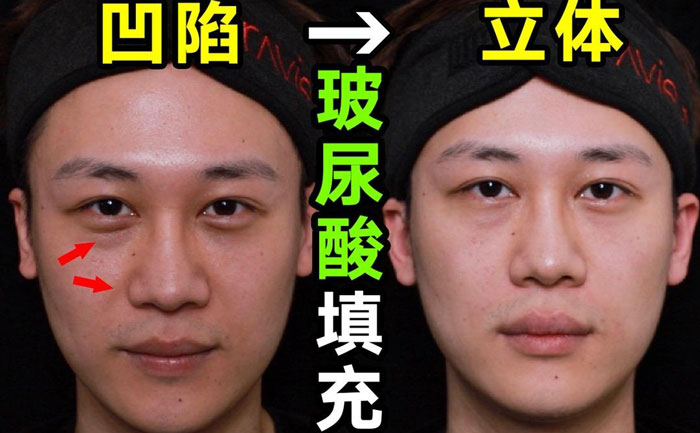 淚溝填充用什么方法最好？淚溝填充手術(shù)大約多少錢？