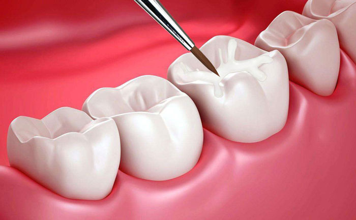 貴金屬烤瓷牙有哪些？貴金屬烤瓷牙的種類