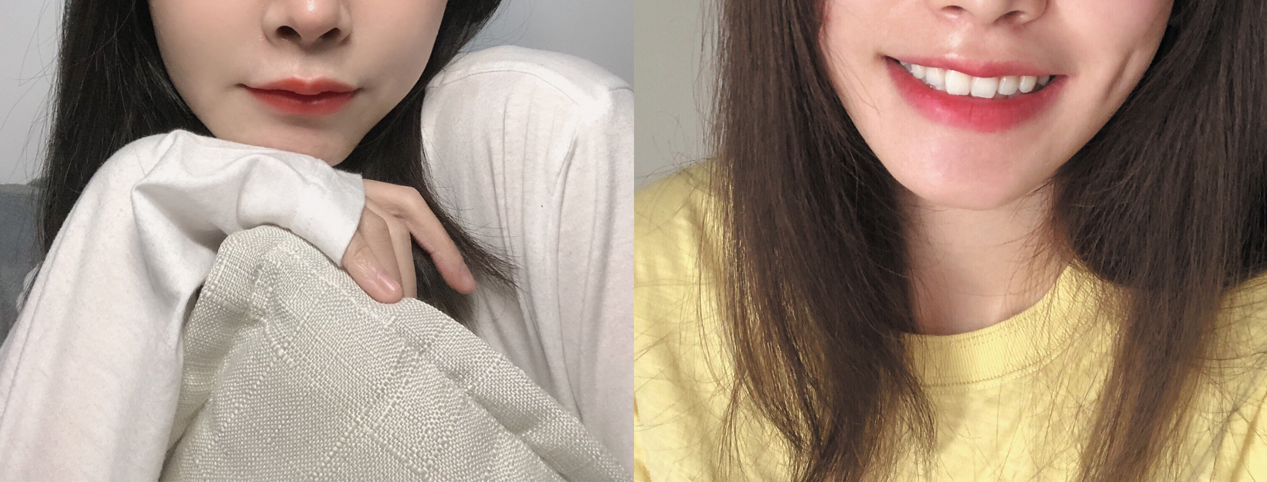 金窩銀窩不如小酒窩~酒窩再造術(shù)，甜美少女?dāng)啬猩衿鳎? data-mce-src=