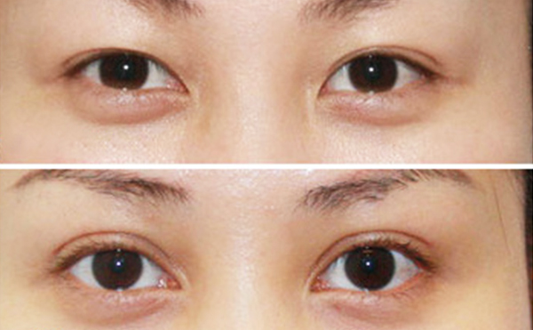 內(nèi)雙做雙眼皮是什么價格？效果怎么樣？