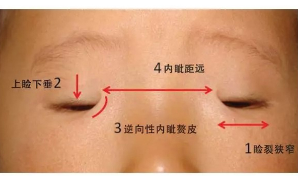 小眼癥是什么?小眼癥是什么原因引起的?