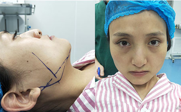 上海首爾麗格樸興植下頜角截骨手術(shù)案例術(shù)前效果