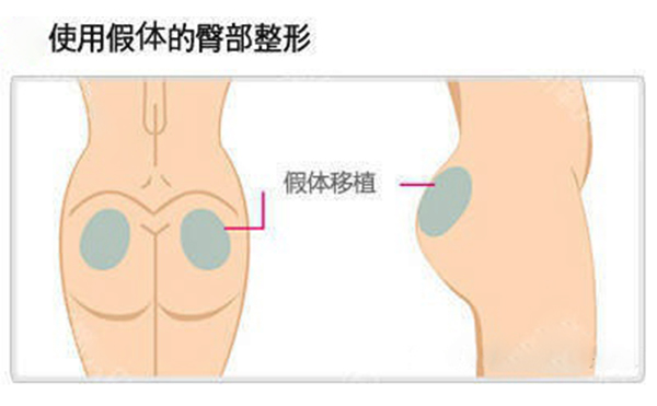 假體豐臀多少錢？假體豐臀效果是永久的嗎？